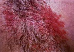 美国超级真菌爆发,致死率60%,中国有18例?先别急,你得了解这些真相